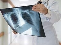 肺部筛查及影像学扫描